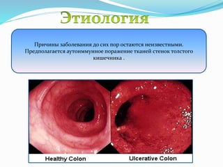 Причины заболевания до сих пор остаются неизвестными.
Предполагается аутоиммунное поражение тканей стенок толстого
кишечника .
 