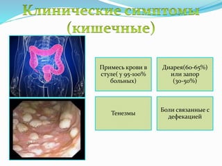 Примесь крови в
стуле( у 95-100%
больных)
Диарея(60-65%)
или запор
(30-50%)
Тенезмы
Боли связанные с
дефекацией
 