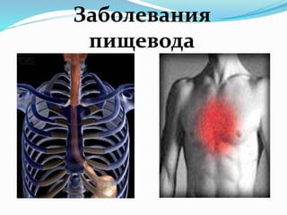 Заболевания
пищевода
 