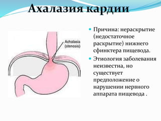  Причина: нераскрытие
(недостаточное
раскрытие) нижнего
сфинктера пищевода.
 Этиология заболевания
неизвестна, но
существует
предположение о
нарушении нервного
аппарата пищевода .
 