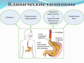 Регургитация
(срыгивание)
Дисфагия
Ощущение
переполнения
в
подложечной
области и за
грудиной
Загрудинная
боль
 