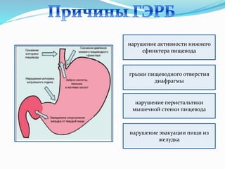 нарушение активности нижнего
сфинктера пищевода
грыжи пищеводного отверстия
диафрагмы
нарушение перистальтики
мышечной стенки пищевода
нарушение эвакуации пищи из
желудка
 