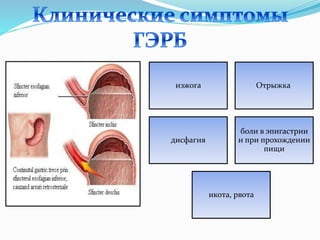 изжога Отрыжка
дисфагия
боли в эпигастрии
и при прохождении
пищи
икота, рвота
 