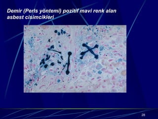 28
Demir (Perls yöntemi) pozitif mavi renk alan
asbest cisimcikleri
 