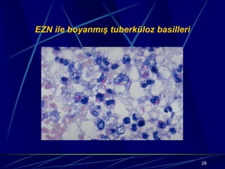 29
EZN ile boyanmış tuberküloz basilleri
 