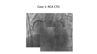 CT guidance for CTO Recanalization