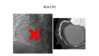 CT guidance for CTO Recanalization
