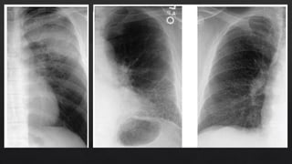Radiografia del patron alveolar y su identificacion | PPTX