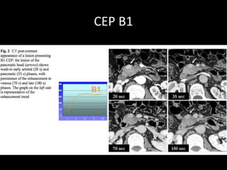 Tcmd Worksheet EL PATRON DE REALCE EN TCMD DE LOS TUMORES ENDOCRINOS PANCREATICOS ...