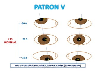 20 Δ
30 Δ
10 Δ
≥ 15
DIOPTRIAS
MAS DIVERGENCIA EN LA MIRADA HACIA ARRIBA (SUPRAVERSION)
Carlos Azañero Inope
 