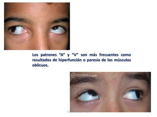 Los patrones “A” y “V” son más frecuentes como
resultados de hiperfunción o paresia de los músculos
oblicuos.
Carlos Azañero Inope
 