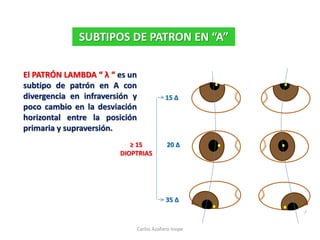 El PATRÓN LAMBDA “ λ “ es un
subtipo de patrón en A con
divergencia en infraversión y
poco cambio en la desviación
horizontal entre la posición
primaria y supraversión.
SUBTIPOS DE PATRON EN “A”
20 Δ
15 Δ
35 Δ
≥ 15
DIOPTRIAS
Carlos Azañero Inope
 