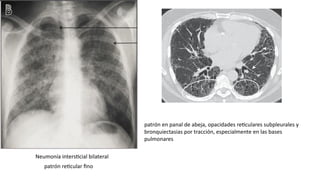 PATRONES DE ENFERMEDAD PULMONARES en imagenologia | PPTX