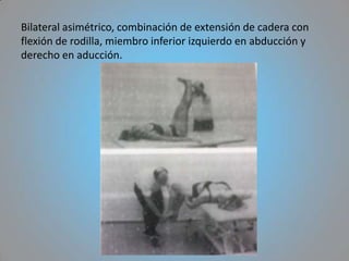 Bilateral asimétrico, combinación de extensión de cadera con
flexión de rodilla, miembro inferior izquierdo en abducción y
derecho en aducción.
 