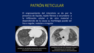 Patrones pulmonares en tomografia de alta resolucion | PPTX