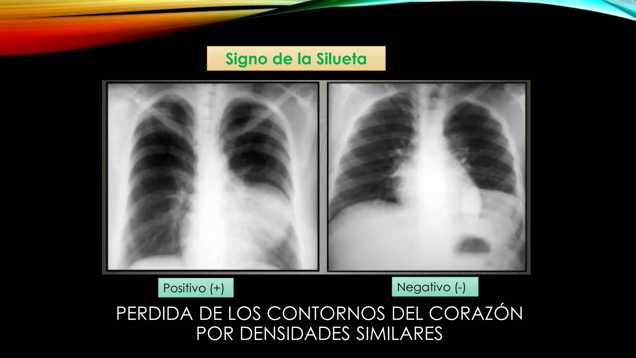 Patrones radiográficos pulmonares rx tcar | PPT