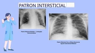 Linfangitis Reticular Patrones radiológicos pulmonares_20240821_225114_0000.pptx