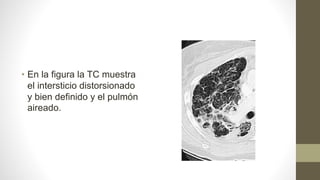 • En la figura la TC muestra
el intersticio distorsionado
y bien definido y el pulmón
aireado.
 