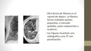 • Otra forma de fibrosis es el
«panal de abeja». La fibrosis
forma múltiples quistes
pequeños, a menudo
apilados, justo subyacentes a
la pleura.
• Las Figuras muestran una
radiografía y una TC con
panalización.
 