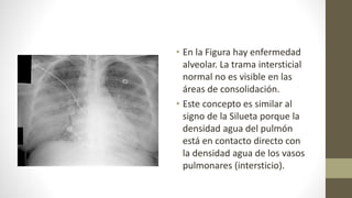 • En la Figura hay enfermedad
alveolar. La trama intersticial
normal no es visible en las
áreas de consolidación.
• Este concepto es similar al
signo de la Silueta porque la
densidad agua del pulmón
está en contacto directo con
la densidad agua de los vasos
pulmonares (intersticio).
 