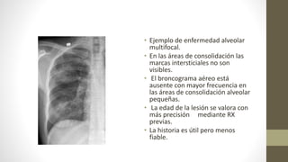 • Ejemplo de enfermedad alveolar
multifocal.
• En las áreas de consolidación las
marcas intersticiales no son
visibles.
• El broncograma aéreo está
ausente con mayor frecuencia en
las áreas de consolidación alveolar
pequeñas.
• La edad de la lesión se valora con
más precisión mediante RX
previas.
• La historia es útil pero menos
fiable.
 