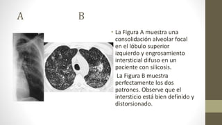 A B
• La Figura A muestra una
consolidación alveolar focal
en el lóbulo superior
izquierdo y engrosamiento
intersticial difuso en un
paciente con silicosis.
• La Figura B muestra
perfectamente los dos
patrones. Observe que el
intersticio está bien definido y
distorsionado.
 