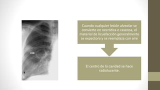 El centro de la cavidad se hace
radiolucente.
Cuando cualquier lesión alveolar se
convierte en necrótica o caseosa, el
material de licuefacción generalmente
se expectora y se reemplaza con aire
 
