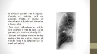 • la cavidad quedan aire y líquido.
Cuando el paciente está en
posición erecta, el líquido se
deposita en el fondo y el aire sube
a lo más alto.
• Este nivel hidroaéreo es visible
sólo cuando el haz de rayos X es
paralelo a la interfase aire-líquido.
• El nivel hidroaéreo no se ve en las
radiografías en supino porque el
haz de rayos X es perpendicular al
nivel hidroaéreo
 