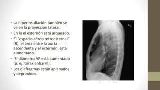 • La hiperinsuflación también se
ve en la proyección lateral.
• En la el esternón está arqueado.
• El “espacio aéreo retroesternal”
(R), el área entre la aorta
ascendente y el esternón, está
aumentado.
• El diámetro AP está aumentado
(p. ej. tórax enbarril).
• Los diafragmas están aplanados
y deprimidos
 