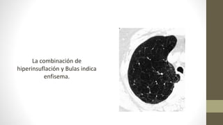 La combinación de
hiperinsuflación y Bulas indica
enfisema.
 
