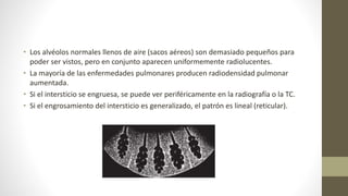 • Los alvéolos normales llenos de aire (sacos aéreos) son demasiado pequeños para
poder ser vistos, pero en conjunto aparecen uniformemente radiolucentes.
• La mayoría de las enfermedades pulmonares producen radiodensidad pulmonar
aumentada.
• Si el intersticio se engruesa, se puede ver periféricamente en la radiografía o la TC.
• Si el engrosamiento del intersticio es generalizado, el patrón es lineal (reticular).
 