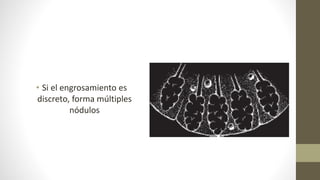 • Si el engrosamiento es
discreto, forma múltiples
nódulos
 