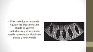• Si los alvéolos se llenan de
líquido, las áreas llenas de
líquido se vuelven
radiodensas, y el intersticio
queda rodeado por el pulmón
blanco y no es visible
 