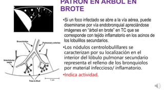Lobulo Infectado HALLASGOZ RADIOLOGICOS DE LA TUBERCULOSIS PULMONAR | PPTX
