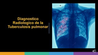 Diagnostico
Radiologico de la
Tuberculosis pulmonar
 