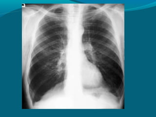 Patrón intersticial
Patrón reticular o reticulonodular
 (pulmón en panal): imagen en forma de
 malla o retícula. Cuando e...
