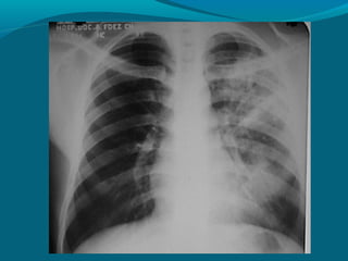 Patrones radiologicos pulmonares