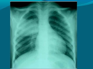Tuberculosis
La primoinfección se puede presentar
 como un aumento de densidad sobre todo
 en lóbulos superiores y regres...