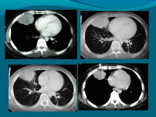 Tromboembolismo pulmonar
La radiografía con frecuencia es normal
 y cuando existen hallazgos son
 inespecíficos (condensa...