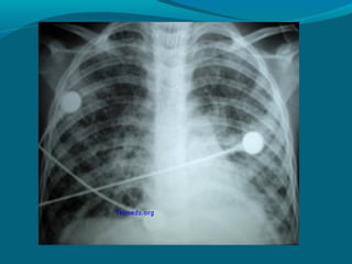 Contusión pulmonar
Como consecuencia de múltiples roturas
 del parénquima sangrado en el tejido
 intersticial y en los es...