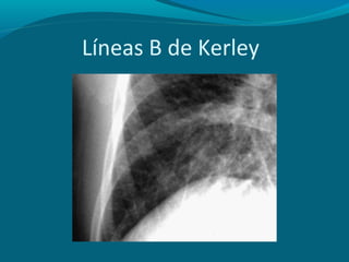 Patrones radiologicos pulmonares
