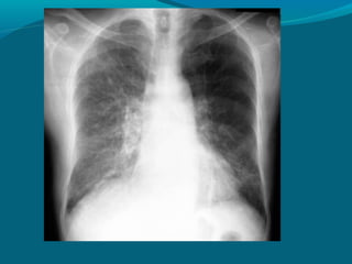 Patrón alveolar
Localizadas: neumonía, contusión
 pulmonar, infarto pulmonar, linfoma o Ca.
 Bronquioalveolar.

Difusas:...