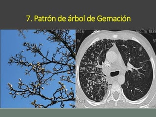 Patrones radiológicos pulmonares un acercamiento diagnóstico | PPT