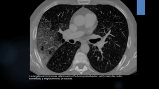 Linfangitis Reticular TC DE TORAX, PRINCIPALES PATRONES TOMOGRAFICOS | PPTX