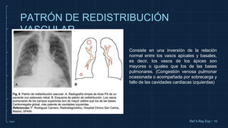 10cm
PATRÓN DE REDISTRIBUCIÓN
VASCULAR
10
Ref X-Ray Exp /
Consiste en una inversión de la relación
normal entre los vasos apicales y basales,
es decir, los vasos de los ápices son
mayores o iguales que los de las bases
pulmonares. (Congestión venosa pulmonar
ocasionada o acompañada por sobrecarga y
fallo de las cavidades cardiacas izquierdas)
 