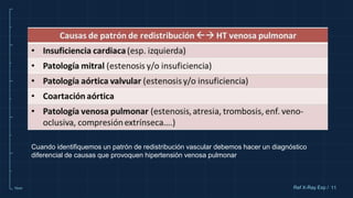 10cm 11
Ref X-Ray Exp /
Cuando identifiquemos un patrón de redistribución vascular debemos hacer un diagnóstico
diferencial de causas que provoquen hipertensión venosa pulmonar
 