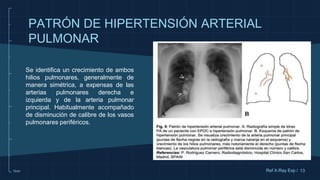 10cm
Se identifica un crecimiento de ambos
hilios pulmonares, generalmente de
manera simétrica, a expensas de las
arterias pulmonares derecha e
izquierda y de la arteria pulmonar
principal. Habitualmente acompañado
de disminución de calibre de los vasos
pulmonares periféricos.
13
PATRÓN DE HIPERTENSIÓN ARTERIAL
PULMONAR
Ref X-Ray Exp /
 