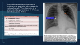 10cm
Una medida a recordar para identificar el
crecimiento de las arterias pulmonares en la
radiografía simple PA es el diámetro de la
arteria interlobar: por encima de 16-17 mm se
considera que está dilatada
15
Ref X-Ray Exp /
 