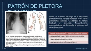 10cm 16
PATRÓN DE PLETORA
PULMONAR
Ref X-Ray Exp /
Indica un aumento del flujo en la circulación
pulmonar lo que provoca dilatación de los vasos
pulmonares centrales y periféricos de manera
bilateral y simétrica, frecuentemente
acompañada de cardiomegalia a expensas del
corazón derecho.
 