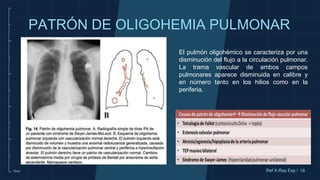 10cm
PATRÓN DE OLIGOHEMIA PULMONAR
El pulmón oligohémico se caracteriza por una
disminución del flujo a la circulación pulmonar.
La trama vascular de ambos campos
pulmonares aparece disminuida en calibre y
en número tanto en los hilios como en la
periferia.
18
Ref X-Ray Exp /
 